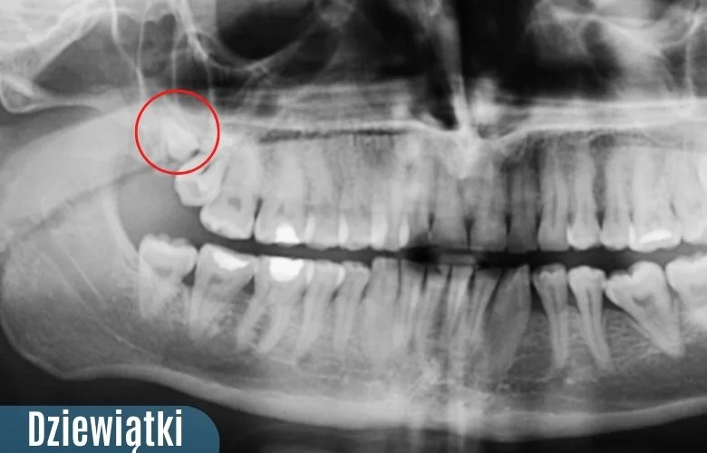 Pantomogram przedstawiający czwarty ząb trzonowy (dziewiątki) nazywany potocznie zębem głupoty