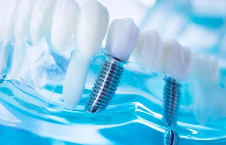 Implanty zębów – najlepsze uzupełnienie braku zęba