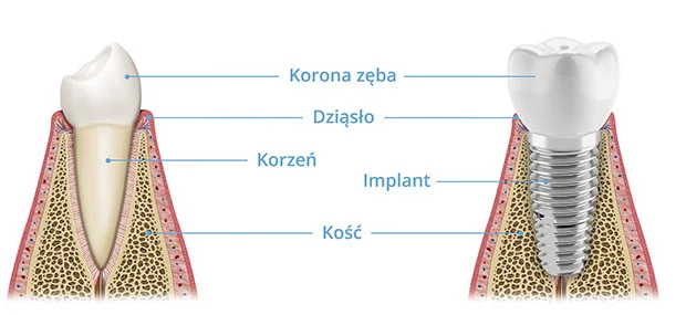 Implanty - PrecisDENT Stomatologia Jasło