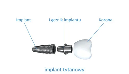Implant tytanowy - PrecisDENT Stomatologia Jasło