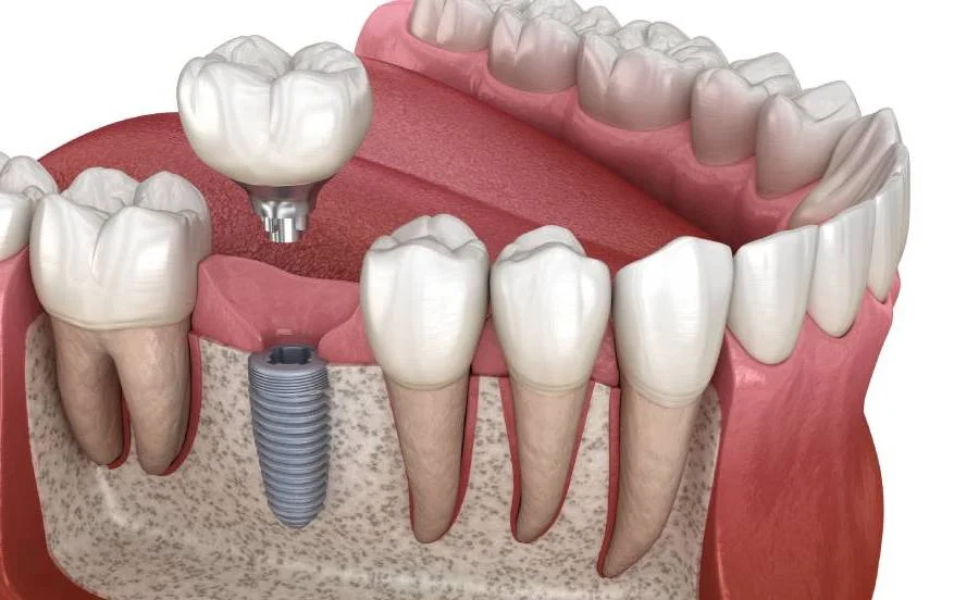 Protetyka - Implanty zębowe PrecisDENT Stomatologia