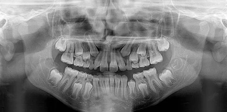 Pantomogram zębów dziecka z widocznym uzębieniem mieszanym stałym i mlecznym, w tym widocznymi zawiązkami zębów mlecznych pod zębami stałymi.