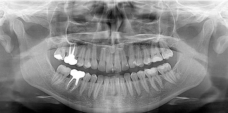 Zdjęcie pantomograficzne pacjenta ze wszystkimi zębami, w tym dwoma leczonymi kanałowo, górnym i dolnym pierwszym zębem trzonowym prawym, w dolnej szóstce prawej jest zacementowany wkład koronowo-korzeniowy.