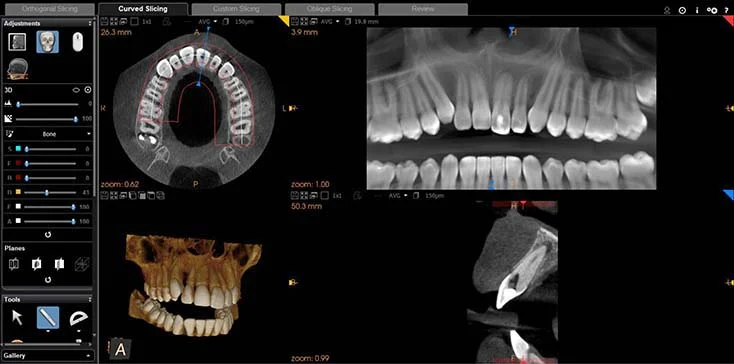 omografia zębów CBCT zębów szczęki i koron zębów dolnych pokazująca zanik kości na skutek stanu zapalnego w okolicy okołowierzchołkowej zęba siecznego pierwszego górnego lewego.