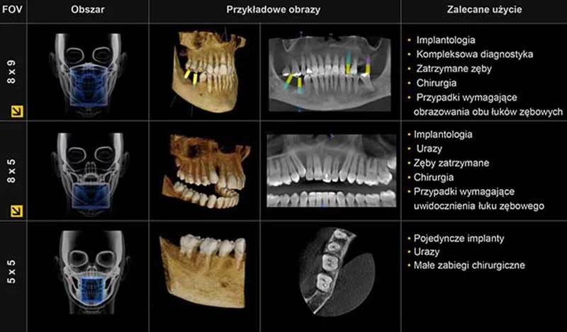 Trzy rodzaje tomografii zębów, pierwsza obrazująca wszystkie zęby używana w implantologii, chirurgii, przy kompleksowej diagnostyce i w przypadkach wymagających na jednym zdjęciu zębów szczęki i żuchwy, jak przy szablonach chirurgicznym przy implantach. Drugi rodzaj tomografii obejmuje zęby dolnej lub górnej szczęki, wykorzystuje się w implantologii, chirurgii, w przypadku zębów zatrzymanych, po urazach zębów i w przypadkach wymagających zdjęcia jednego łuku zębowego. Trzecia tomografia zębów obejmuje kilka zębów obok siebie, wykonuje się ją przy wprowadzaniu pojedynczych implantów, przy małych zabiegach chirurgicznych i po urazach zębów.
