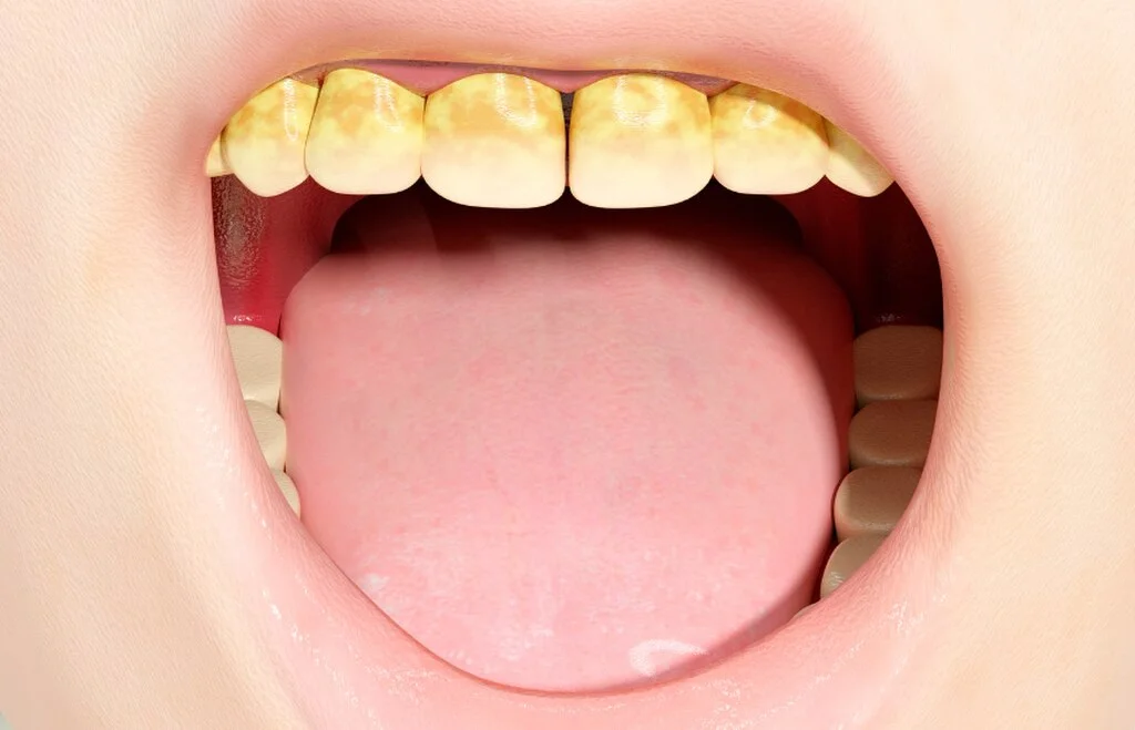 ilustracja przestawiająca kamień nazębny na zębach przy otwartych ustach