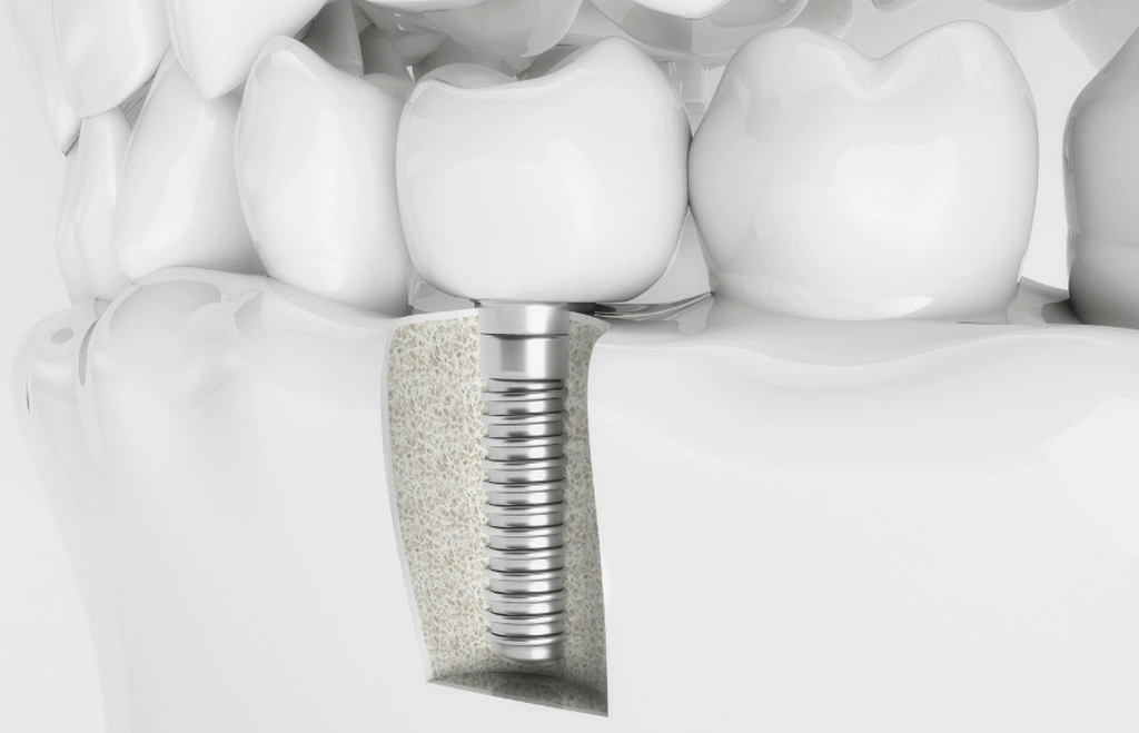 model przedstawiający implanty zębów w powiększeniu