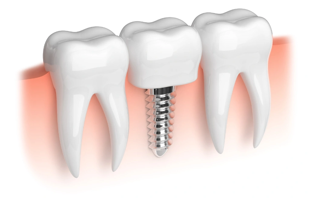 implant zęba między dwoma zębami