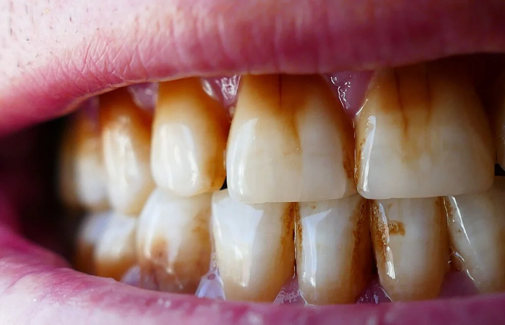 przebarwienia na zębach z powodu płytki nazębnej i kamienia nazębnego