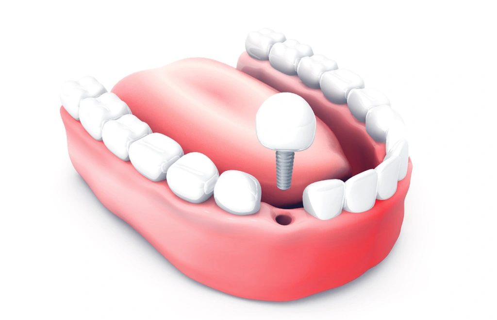 Ilustracja pokazująca brak jednego zęba, który ma być uzupełnieniowy implantem z koroną