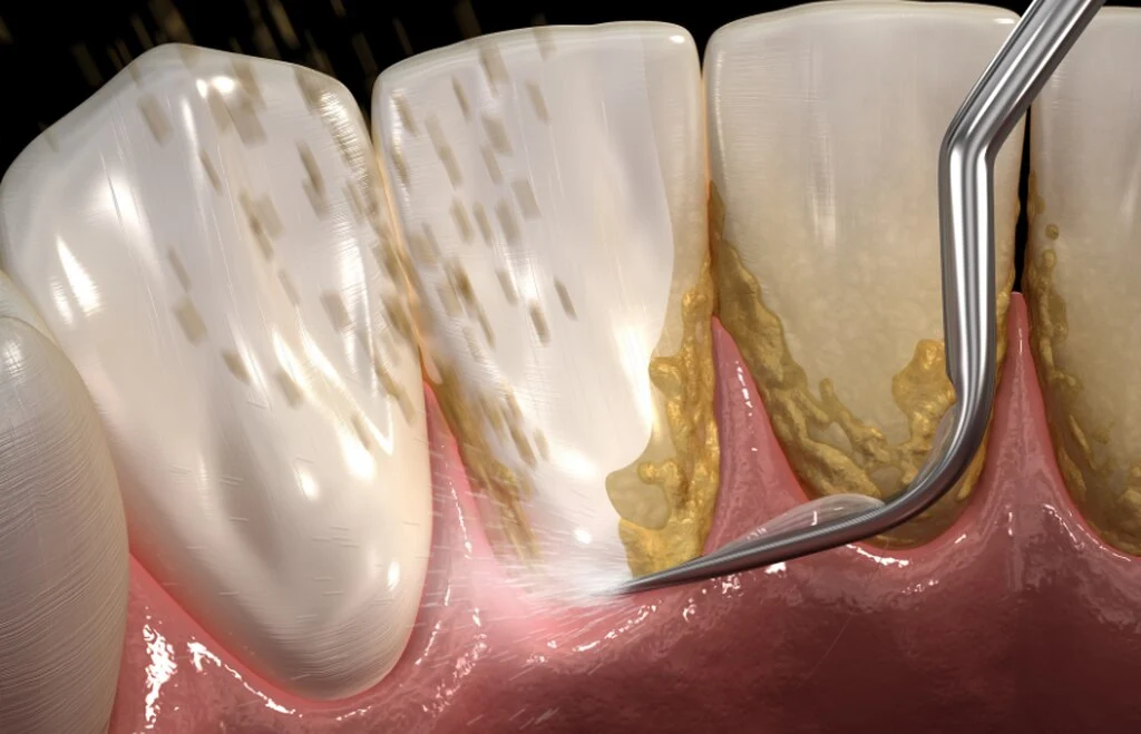 Ilustracja przedstawiająca usuwanie kamienia nazębnego z zębów skalerem ultradźwiękowym