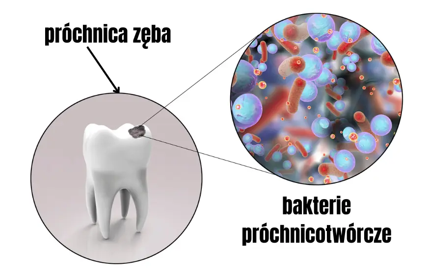 schemat pokazujący zęba z próchnicą i powiększenie na bakterie próchnicotwórcze