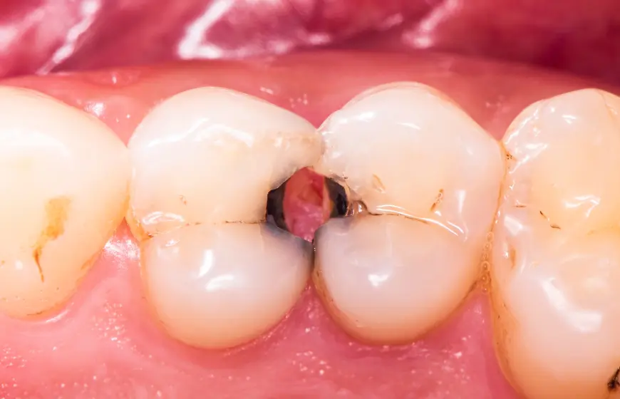 Dziura w zębie czyli ubytek tkanek zęba, w tym zębiny i szkliwa