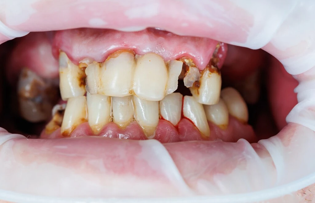 Zęby górne i dolne w zwarciu z rozległą próchnicą i dużymi nieszczelnymi wypełnieniami oraz kilkoma brakami zebowymi