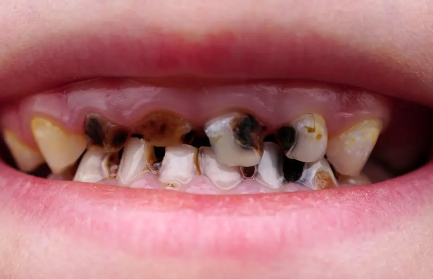 próchnica ostra manifestująca się jako dziura w zębie u dziecka na wszystkich zębach przednich górnych i dolnych