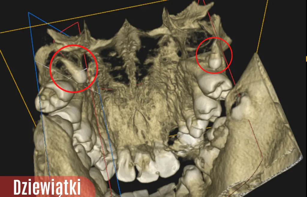 Zęby dziewiąte widoczne na rekonstrukcji 3d z tomografii zębów. Dziewiątki potocznie nazywane są zębami głupoty.