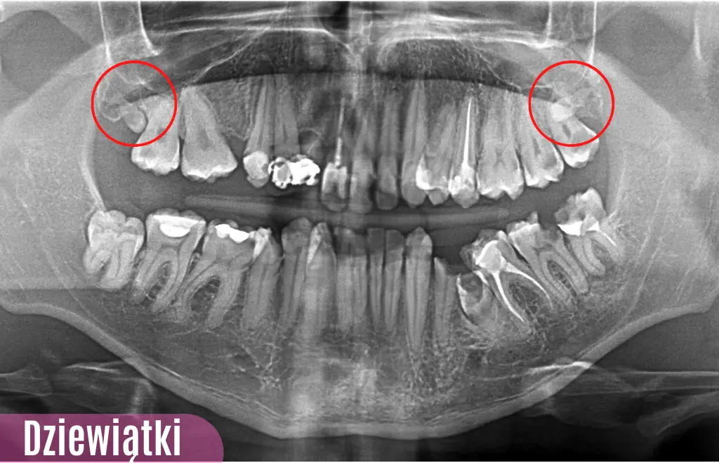Dwie Dziewiątki, potocznie zwane zębami głupoty, obecne na zdjęciu pantomograficznym w szczęce. Zdjęcie pantomograficzne wykonane w PrecisDENT Centrum Implantologii i Stomatologii Mikroskopowej w Jaśle