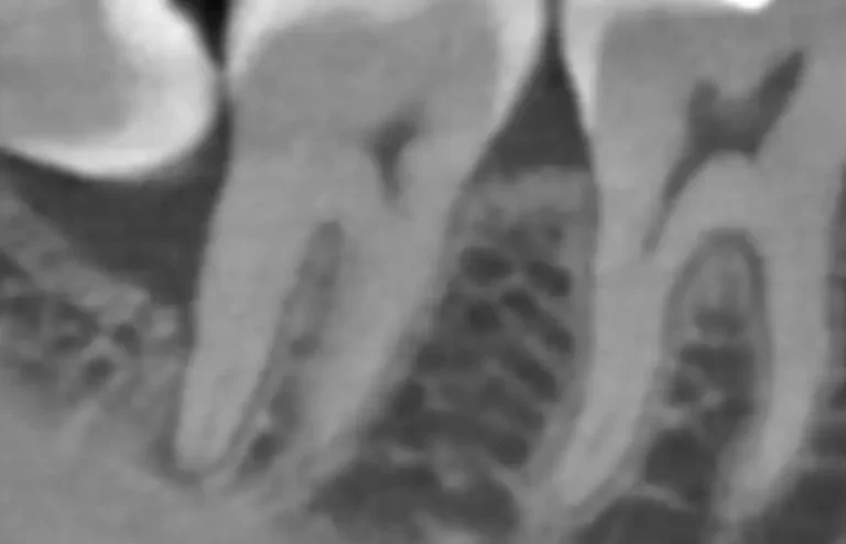 Rtg zębów – jak wygląda rentgen stomatologiczny