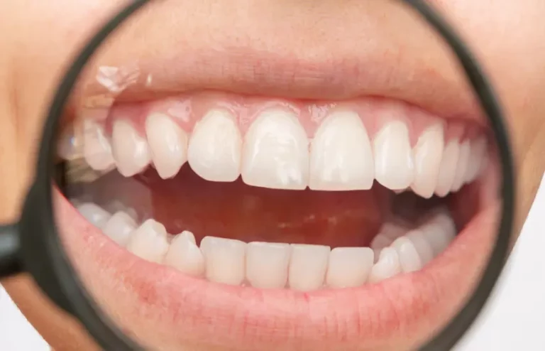 Leczenie białych plam na powierzchniach zębów. Skąd się biorą i jak je leczyć?