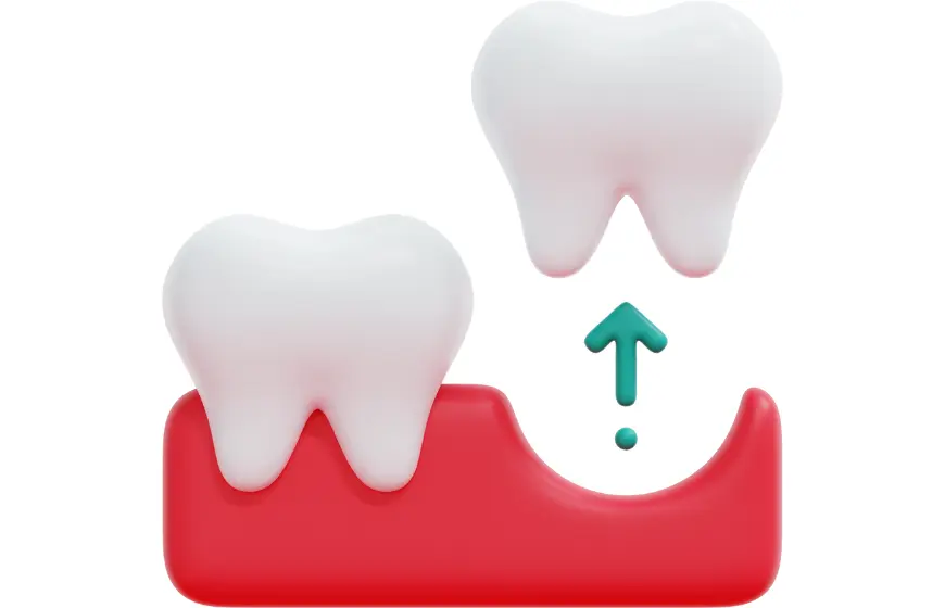 Schemat przestawiający proces usuwania zęba i zapadnięcie się dziąsła po usunięciu