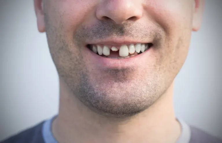 Pęknięty ząb – i co dalej?