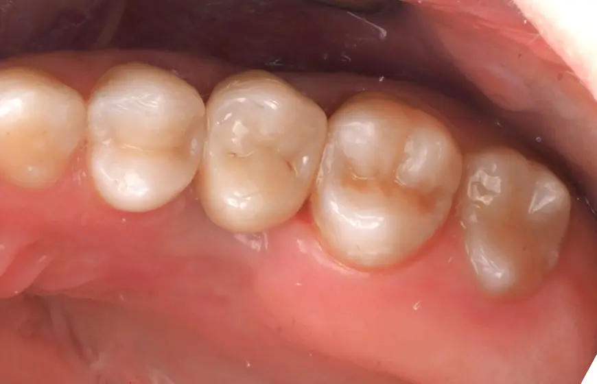 Prawidłowe wypełnienie zęba, czyli Plomby o prawidłowej anatomii zęba
