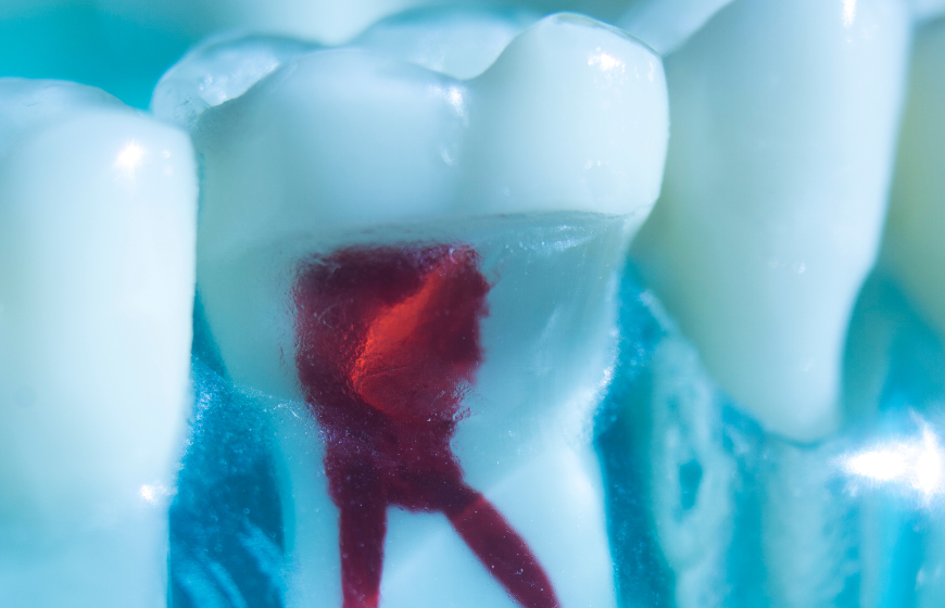 Model anatomiczny zęba przedstawiający przekrój miazgi z widocznym stanem zapalnym i infekcją.