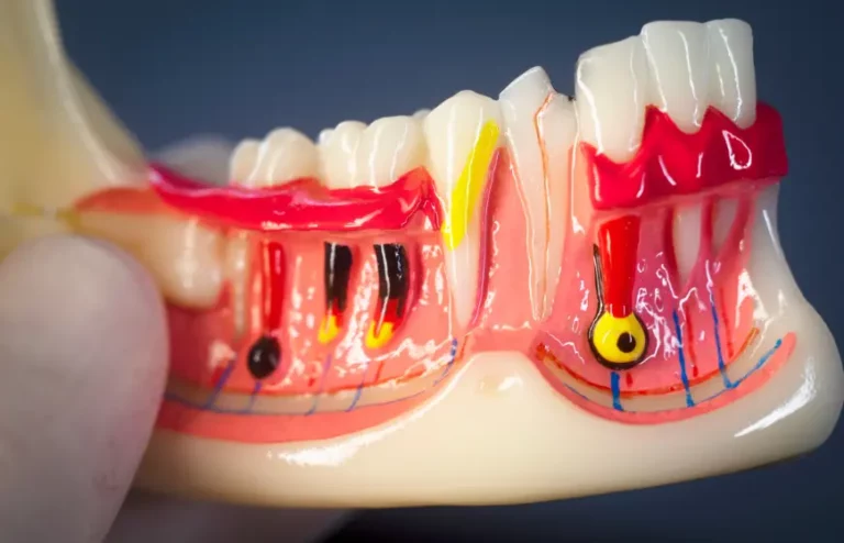 Zgorzel zęba – przyczyny, objawy i skuteczne metody leczenia