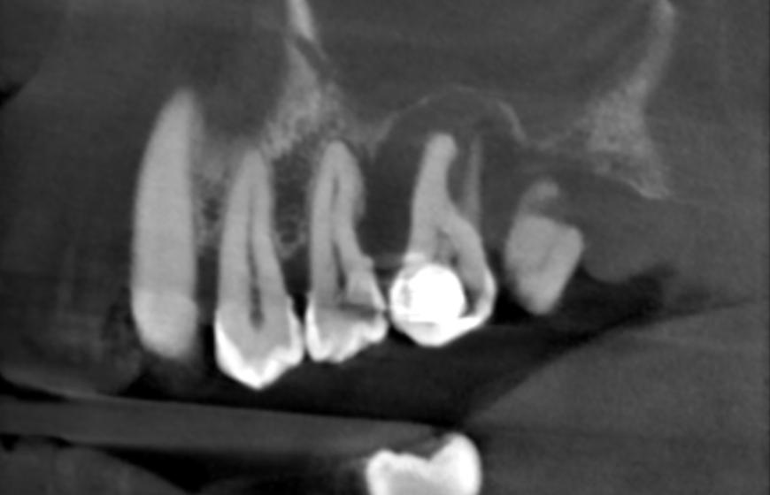 Obraz rentgenowski pokazujący zmianę okołowierzchołkową zęba na tomografii stożkowej, wskazującą na infekcję.
