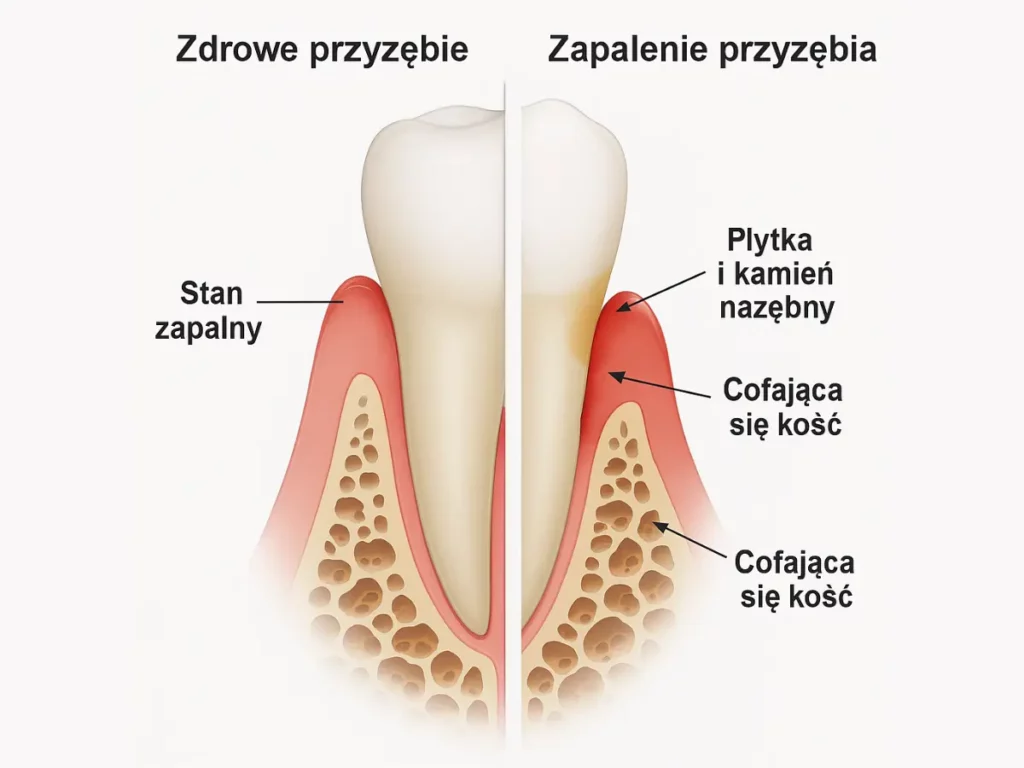 Ilustracja porównawcza zdrowego przyzębia i przyzębia z zapaleniem, ukazująca stan zapalny, płytkę i kamień nazębny oraz cofającą się kość.