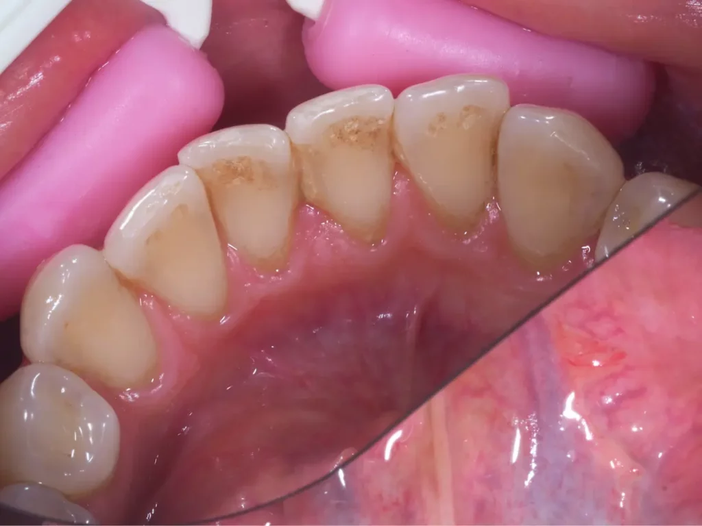 Zbliżenie dolnych zębów z brązowym osadem przy linii dziąseł przed zabiegiem higienizacji