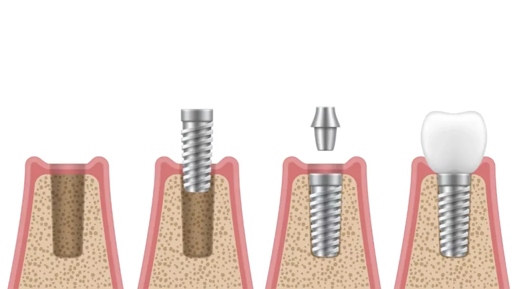 implant zeba protokol tradycyjny