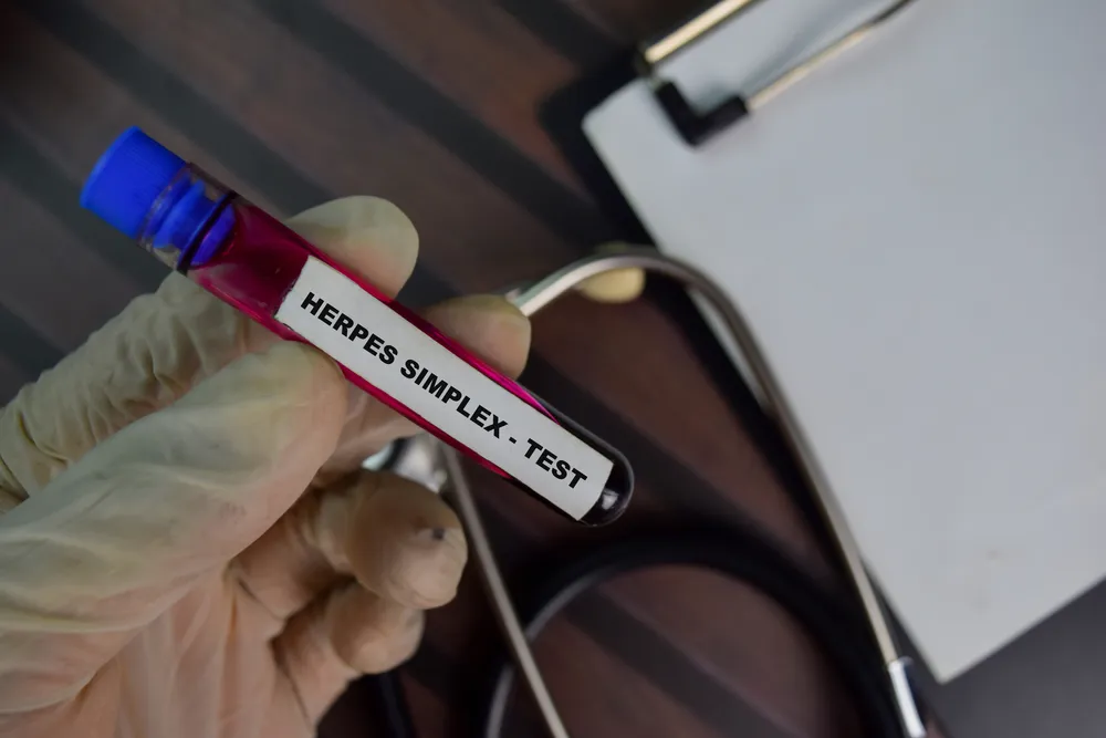 Probówka z etykietą Herpes Simplex Test - badanie laboratoryjne do diagnostyki opryszczki, test serologiczny wykrywający przeciwciała HSV-1 i HSV-2