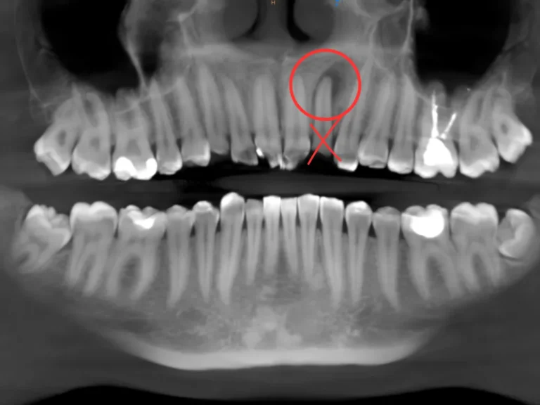 Dwójka do usunięcia? Ratowanie dwójki z zaawansowaną zmianą. Przypadek kliniczny