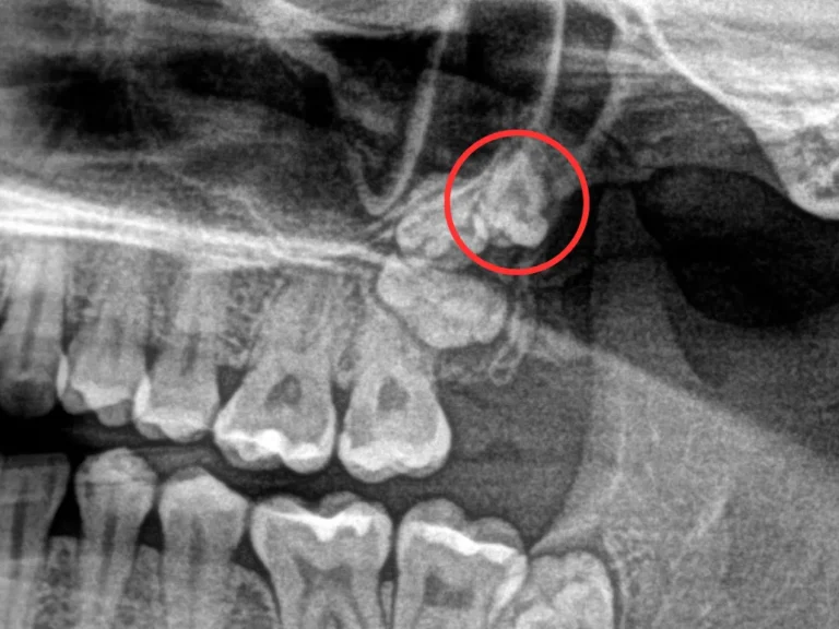 Ząb dziesiąty (dziesiątka). Co musisz wiedzieć o piątym zębie trzonowym?