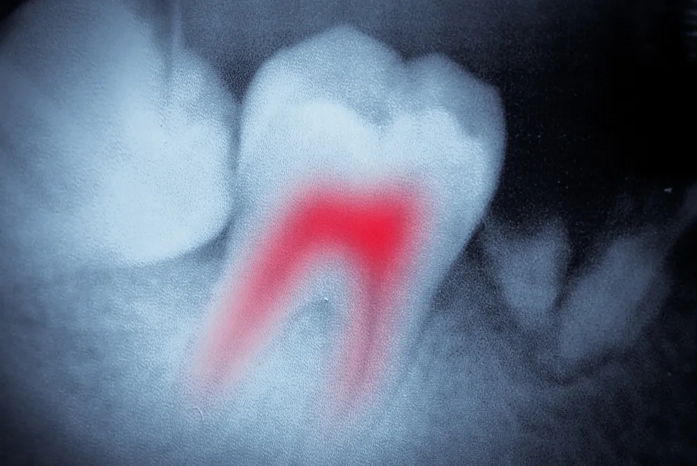 Wizualizacja anatomicznego modelu przekroju zęba pokazujący miazgę z naczyniami krwionośnymi i nerwami - struktura żywej miazgi zębowej, na zdjęciu RTG