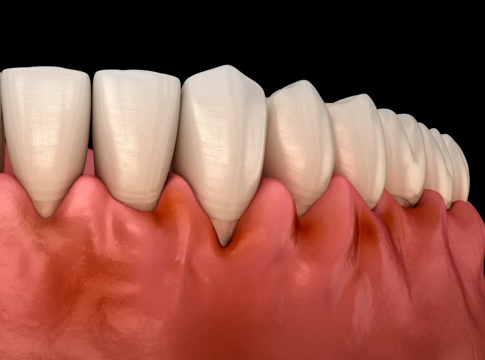 Zapalenie dziąseł - gingivitis. Obraz 3D dolnego łuku zębowego z widocznym zapaleniem dziąseł - zaczerwienione i obrzęknięte dziąsła wokół zębów
