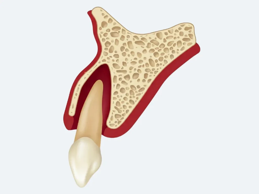 zwichniecie zeba przedniego