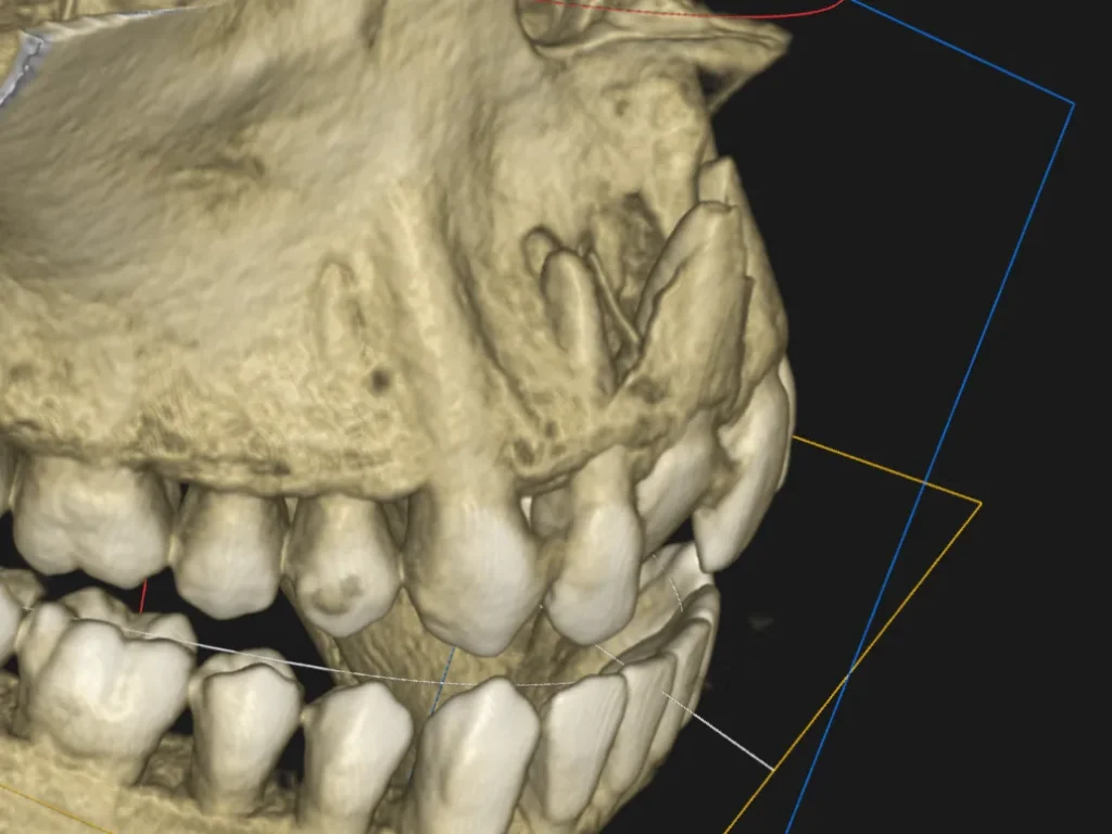 obraz na podstawie tomografii stożkowej przestawiający zwichnięcie zęba. a właściwie aż 3 obok siebie z urazem kości