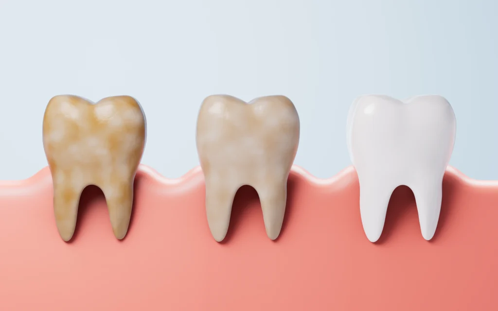 Trójwymiarowa grafika przedstawiająca trzy zęby w dziąśle, ukazująca stopniowe przebarwienie: od brązowego zęba po lewej, przez lekko przebarwiony w środku, do białego zęba po prawej.