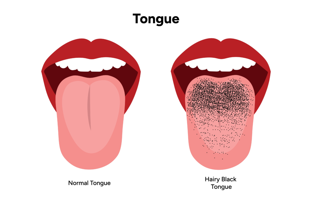 Ilustracja medyczna porównująca normalny język z językiem włochatym. Po lewej stronie różowy, zdrowy język, po prawej język z charakterystycznymi czarnymi kropkami na środkowej części przedstawiającymi przerosnięte brodawki nitkowate typowe dla hairy black tongue.
