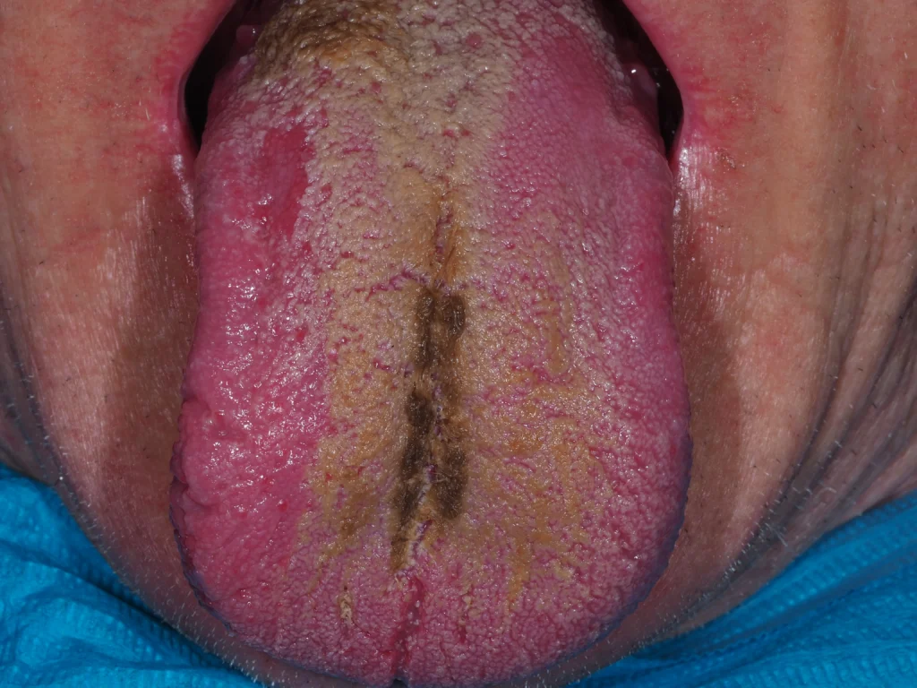 Kliniczne zdjęcie języka włochatego pokazujące brunatno-żółtawy nalot na środkowej i tylnej części języka z wydłużonymi brodawkami nitkowatymi. Widoczne charakterystyczne "włochate" struktury na powierzchni języka.