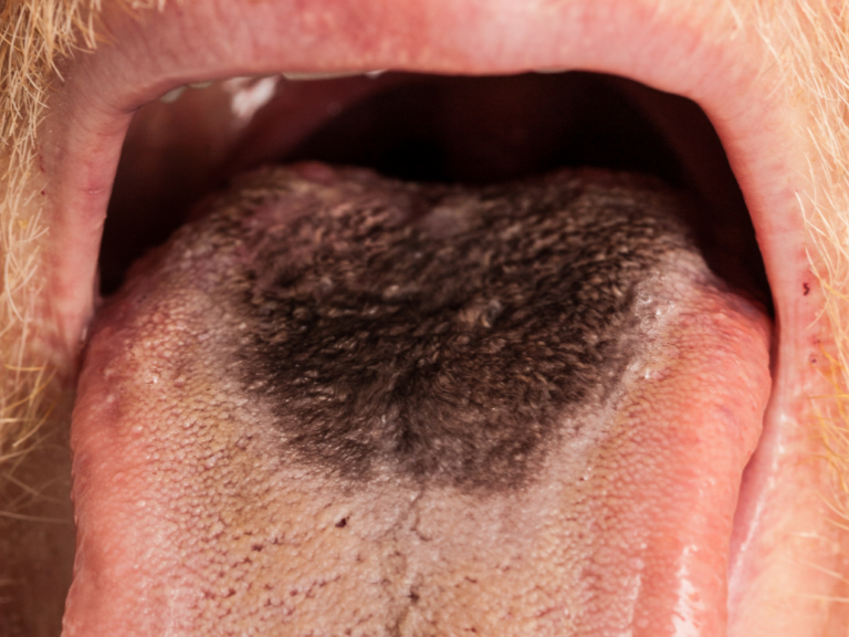 Język włochaty (czarny włochaty język) – przyczyny, objawy, leczenie i profilaktyka