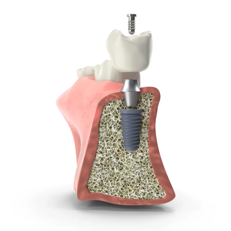 Osteointegracja – jak przebiega zrastanie implantu z kością i od czego zależy sukces leczenia?