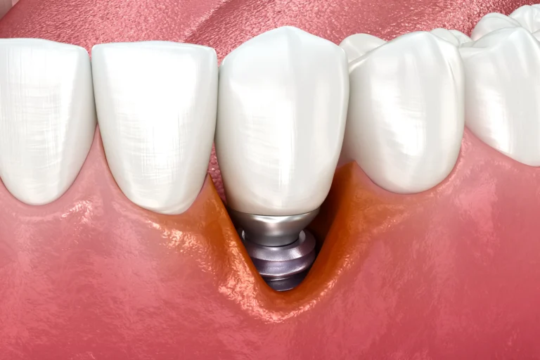 Periimplantitis – zapalenie wokół implantów zębowych